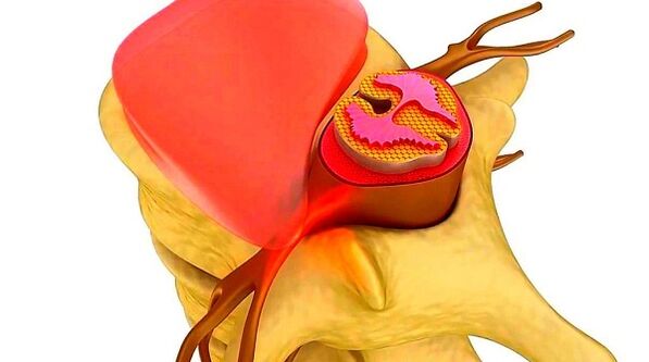 Osteochondrosis of the thoracic column The essence of the disease
