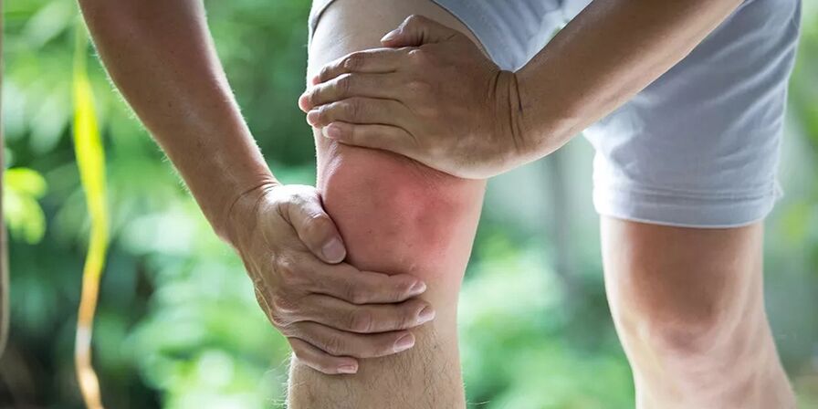 Severe pain during physical activity due to osteoarthritis of the knee joint.